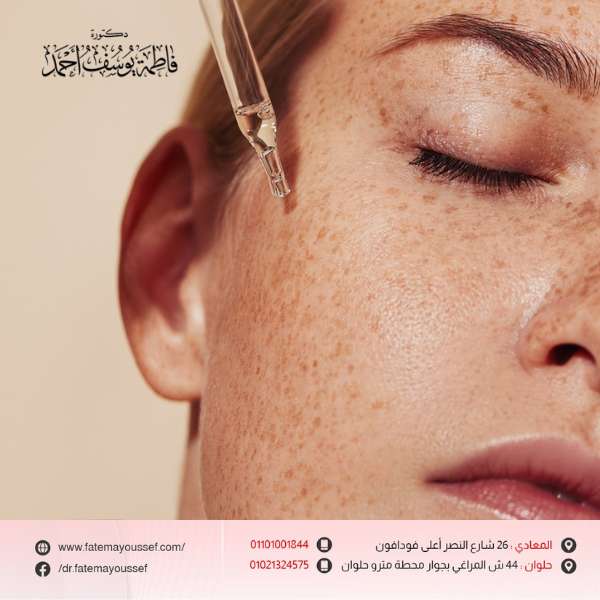 علاج النمش نهائياً