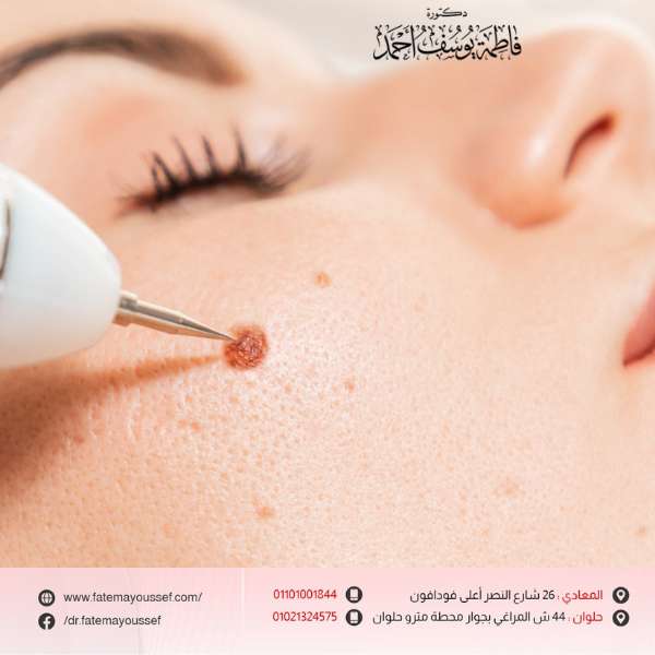 تجربتي مع إزالة الشامات بالليزر