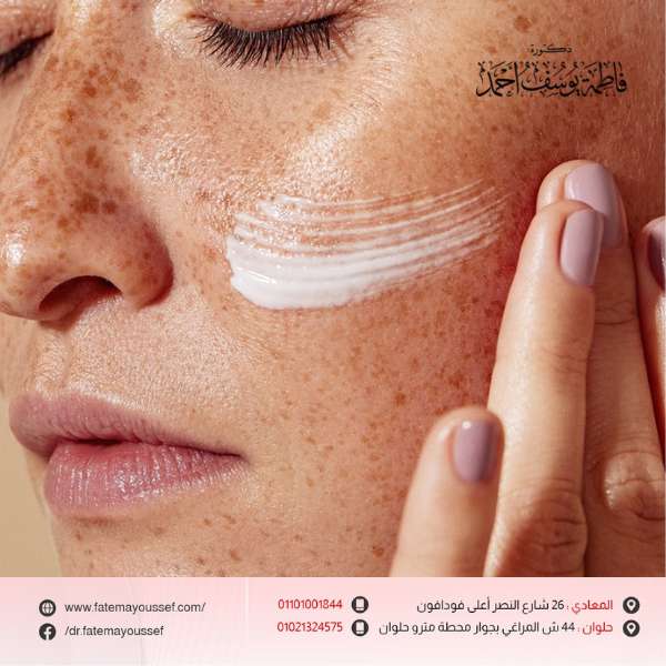 علاج النمش نهائياً