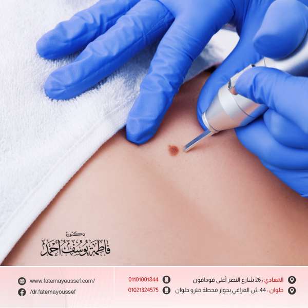 تجربتي مع إزالة الشامات بالليزر
