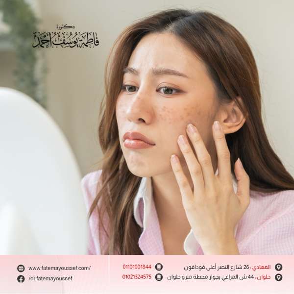 علاج النمش نهائياً