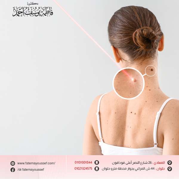 تجربتي مع إزالة الشامات بالليزر