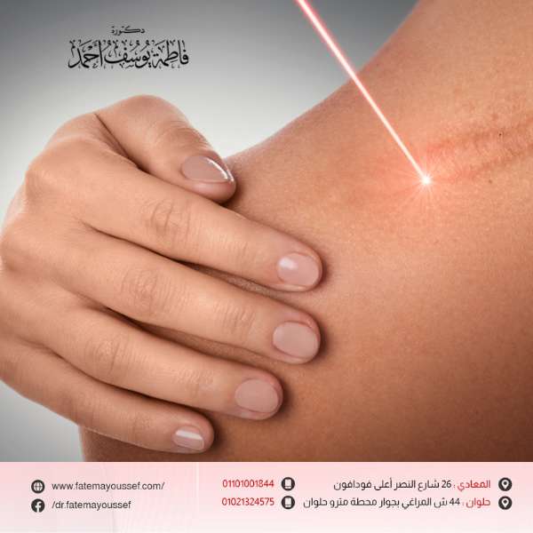 سعر جلسة الليزر لازالة اثار الجروح في مصر