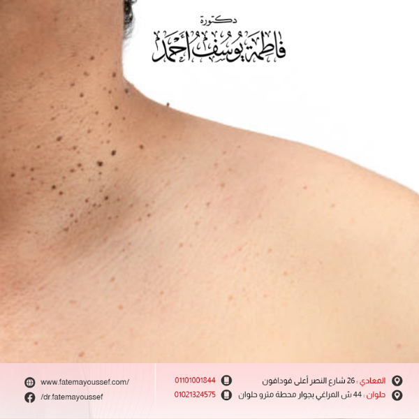 أسباب ظهور الزوائد الجلدية في الرقبة