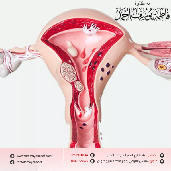 أشكال الزوائد الجلدية في المهبل