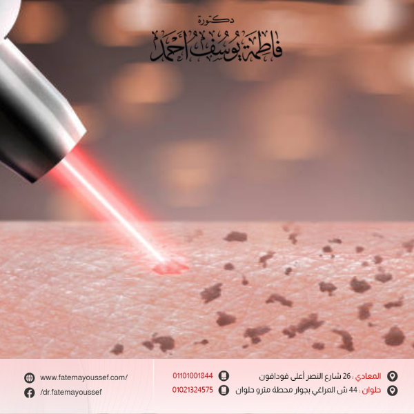 ليزر تفتيح الجسم والمناطق الحساسة