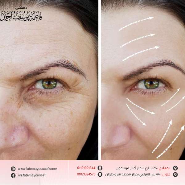 بوتكس الوجه قبل وبعد