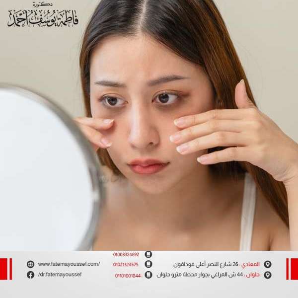 كيفية إزالة الهالات السوداء تحت العين بأسرع وقت للنساء