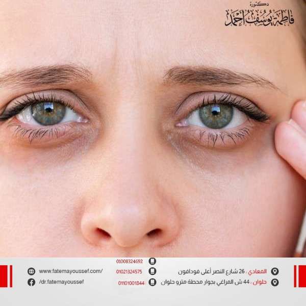 احسن علاج للهالات السوداء حول العين