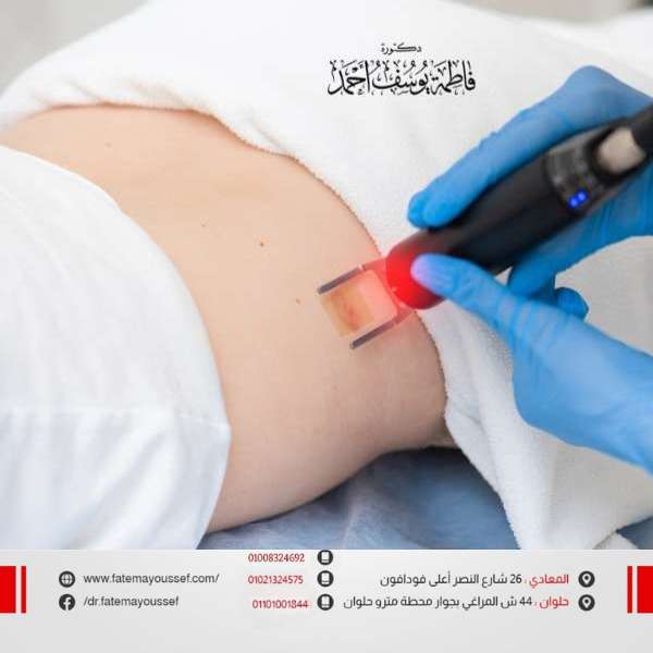 سعر جلسة الليزر لازالة اثار الجروح في مصر