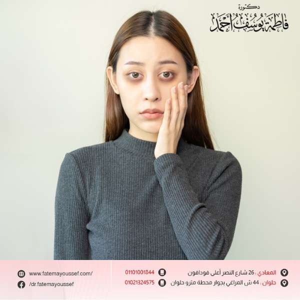 ازالة الهالات السوداء الوراثية