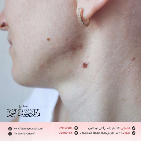 الزوائد الجلدية المؤلمة