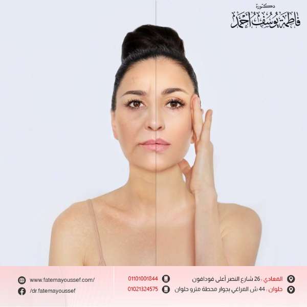 بوتكس الوجه قبل وبعد