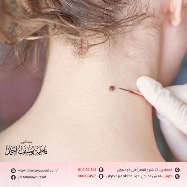 الزوائد الجلدية المؤلمة