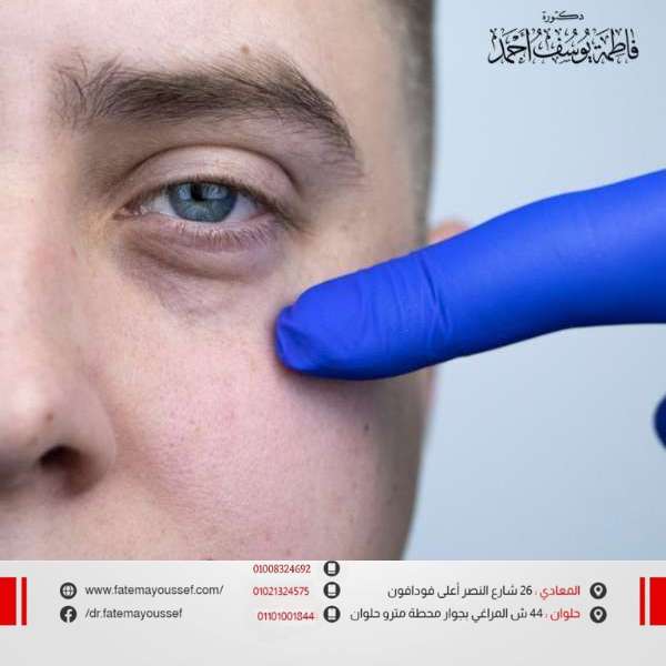 ازالة الهالات السوداء تحت العين للرجال