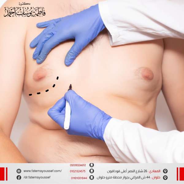 عملية شفط الدهون من الثدي للرجال