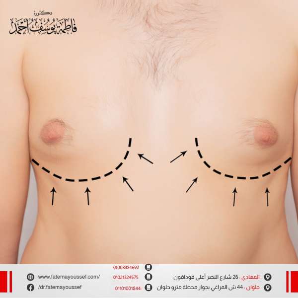 عملية شفط الدهون من الثدي للرجال