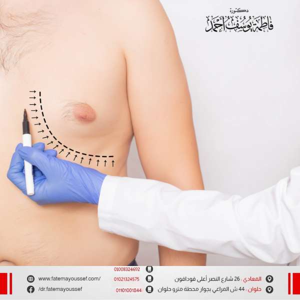عملية شفط الدهون من الثدي للرجال