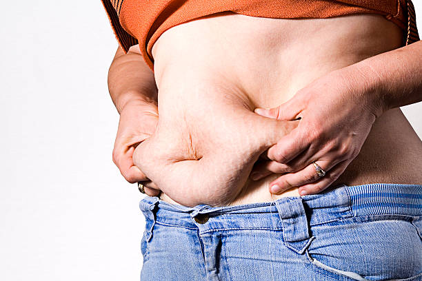 عملية ازالة الكرش المترهل