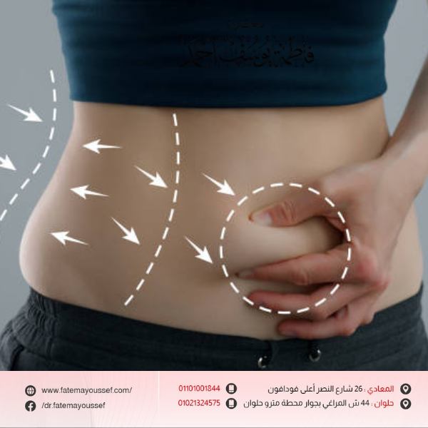 أسعار عمليات الشد بعد التكميم