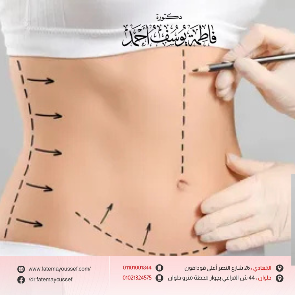 أسعار عمليات الشد بعد التكميم