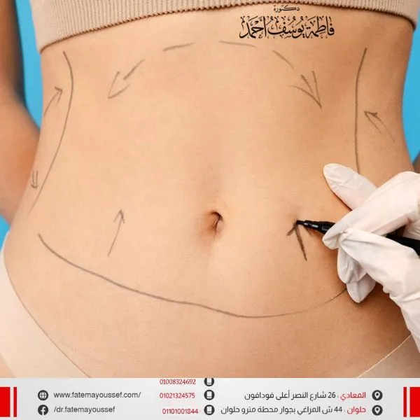 اضرار عملية شفط الدهون من البطن
