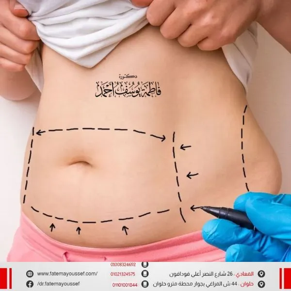 اضرار عملية شفط الدهون من البطن