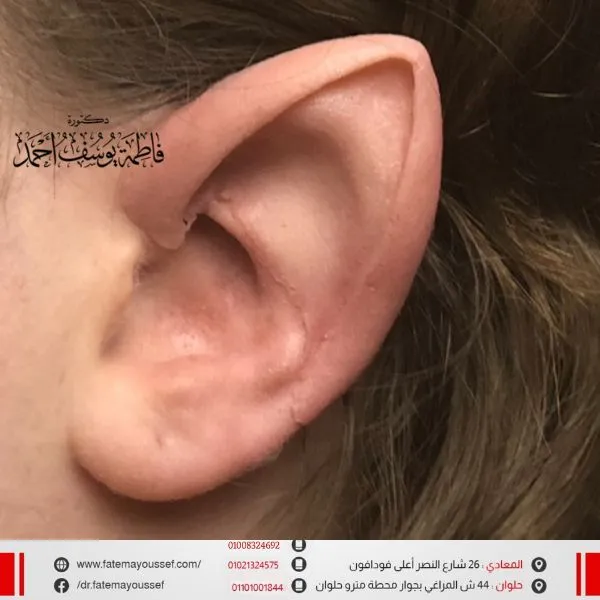 عمليات تجميل الاذن الخفاشية في مصر