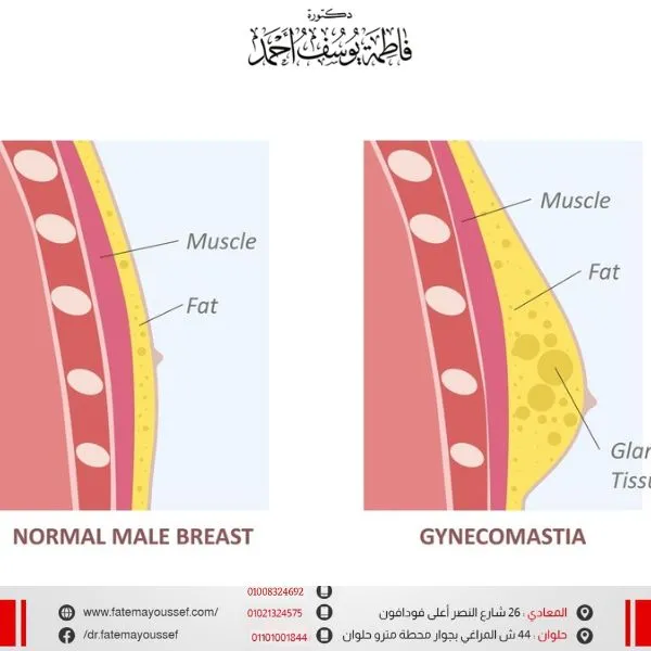 عملية التثدي عند الرجال بالليزر