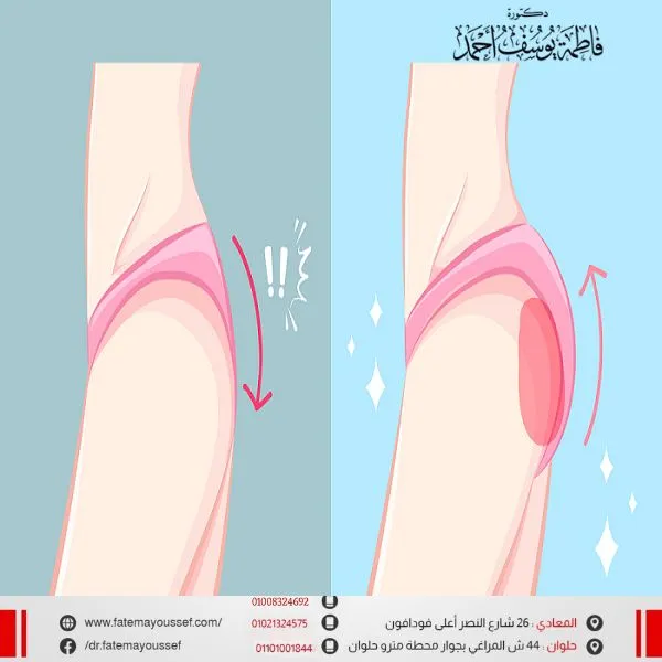 عملية تكبير المؤخرة بالسيليكون