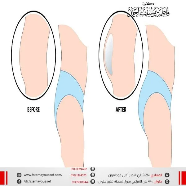 عملية تكبير المؤخرة بالسيليكون