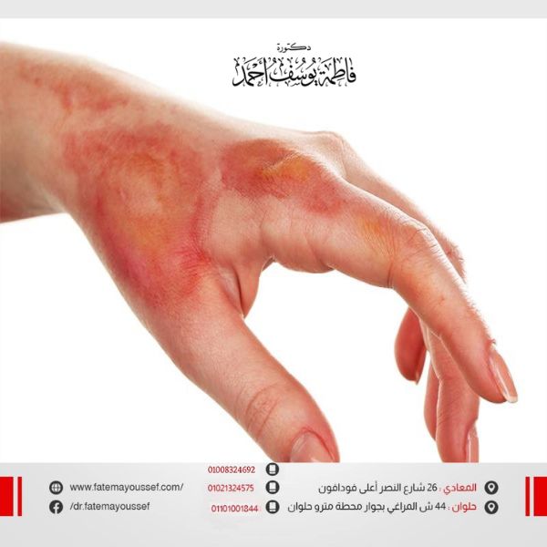 علاج حروق الماء الساخن