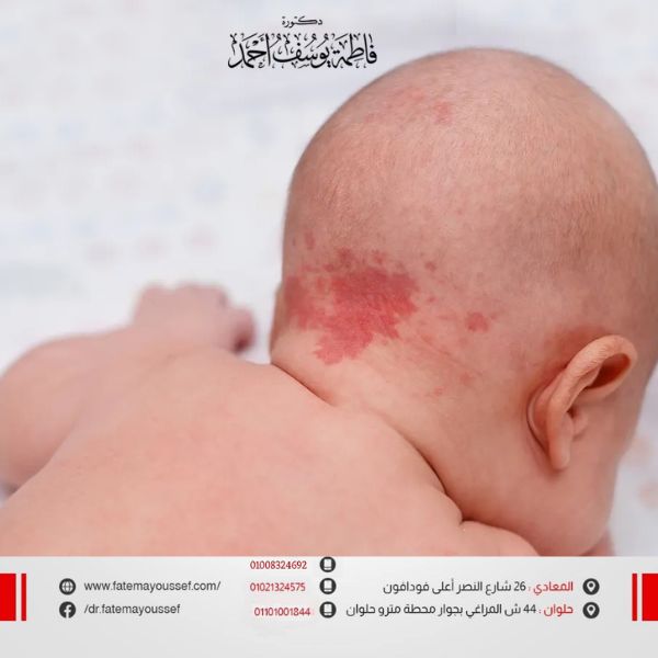 علاج الوحمه الدمويه للاطفال