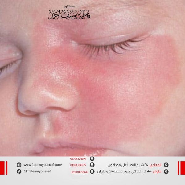 علاج الوحمه الدمويه للاطفال