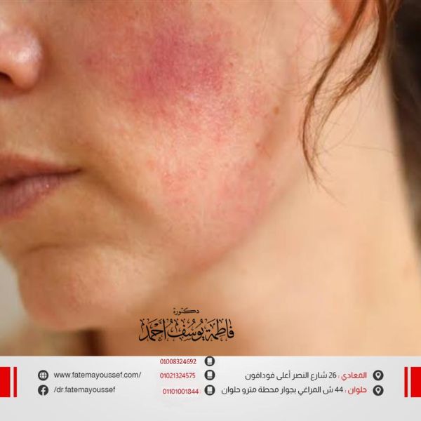 علاج الوحمه الدمويه للاطفال