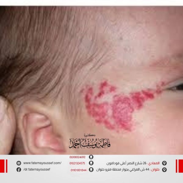 علاج الوحمه الدمويه للاطفال