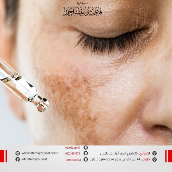 أسباب التصبغات في الوجه