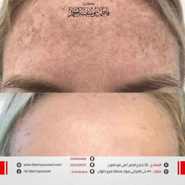 أسباب التصبغات في الوجه