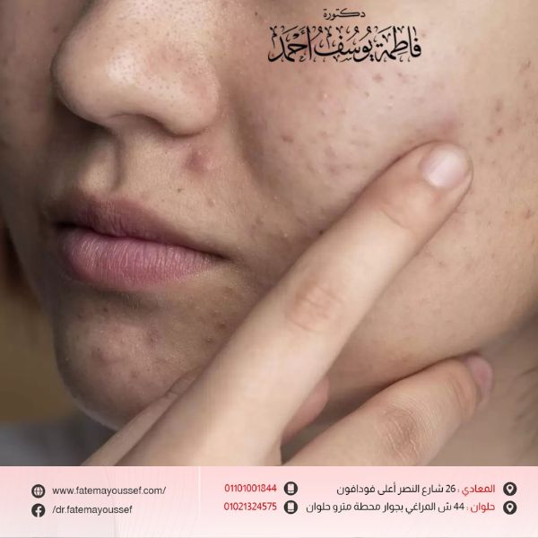 أسباب التصبغات في الوجه