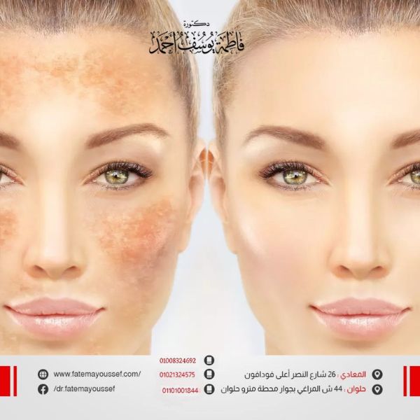 أسباب التصبغات في الوجه