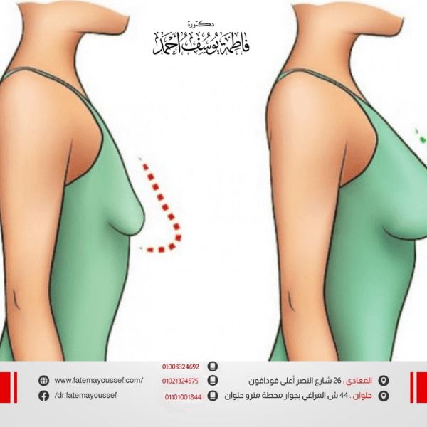 أسباب ترهل الثدي في سن صغير