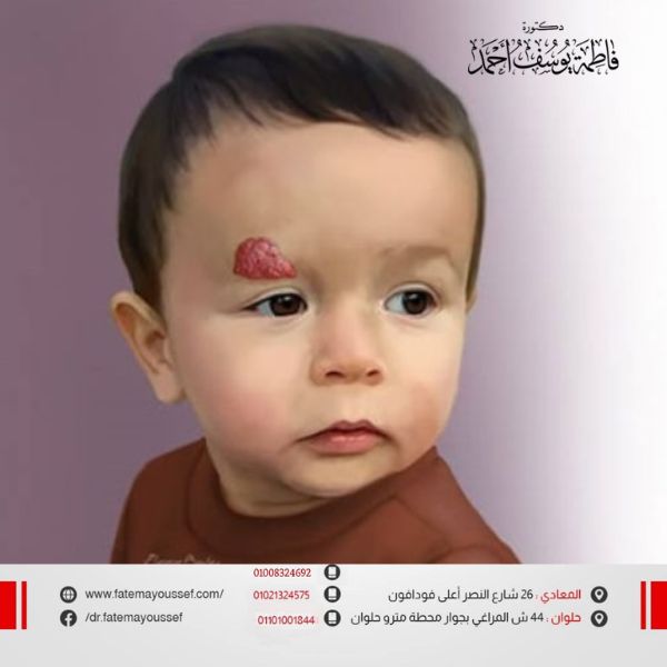 الوحمة الدموية في الرأس