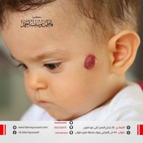 الوحمة الدموية في الرأس