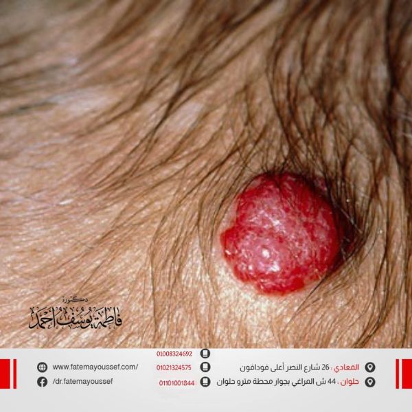 الوحمة الدموية في الرأس