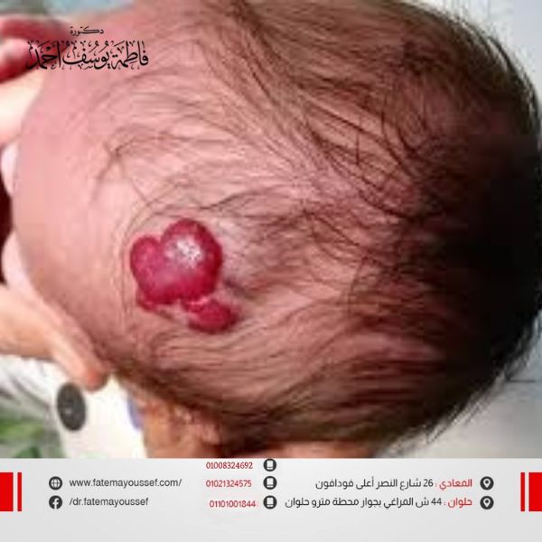 الوحمة الدموية في الرأس
