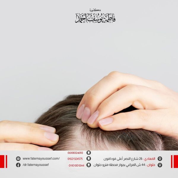 تجربتي مع الصلع الوراثي للنساء