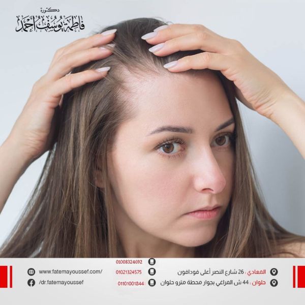 تجربتي مع الصلع الوراثي للنساء