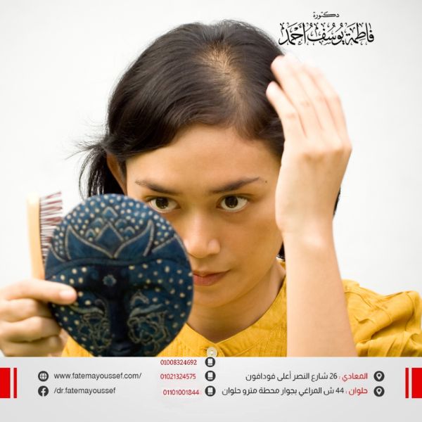 تجربتي مع الصلع الوراثي للنساء