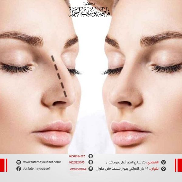 تصغير الأنف بدون جراحة