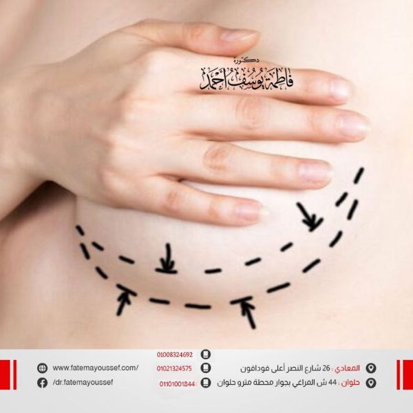 زراعة الثدي بعد استئصاله